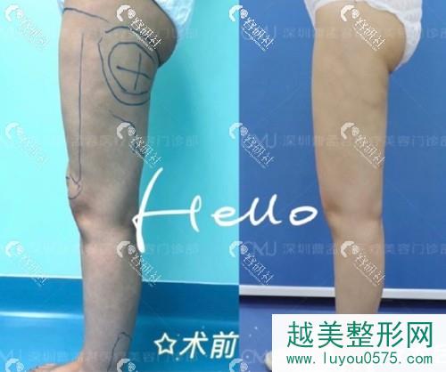 深圳曹孟君医疗美容门诊部大腿吸脂案例