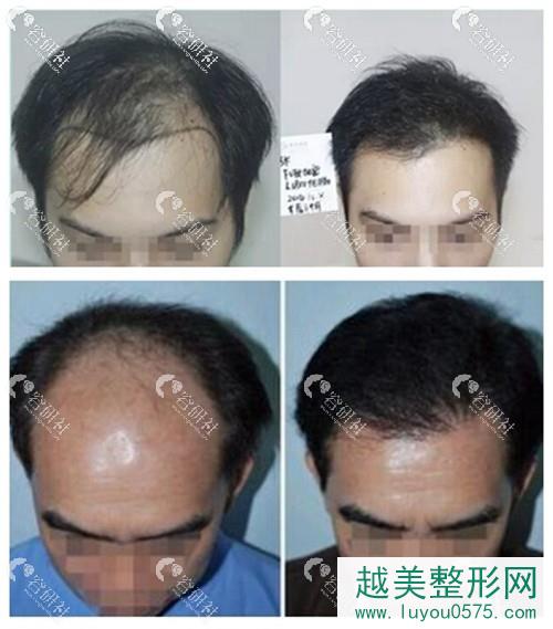 西安雍禾植发种头发案例分享