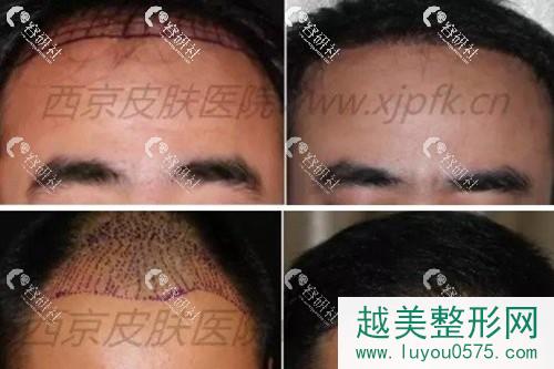 西安西京医院植发科头发种植案例