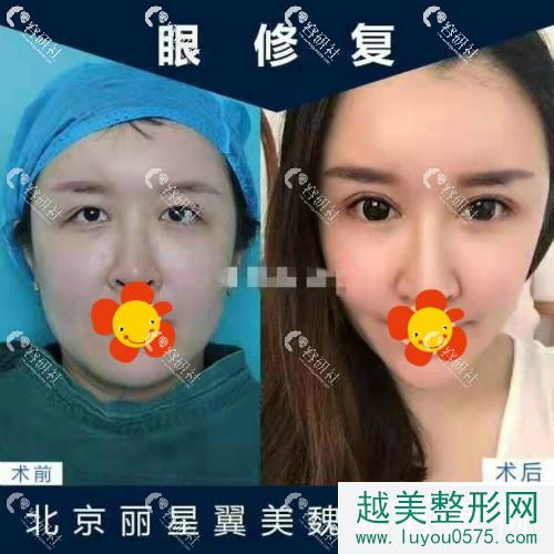 北京丽星翼美医疗美容双眼皮修复案例