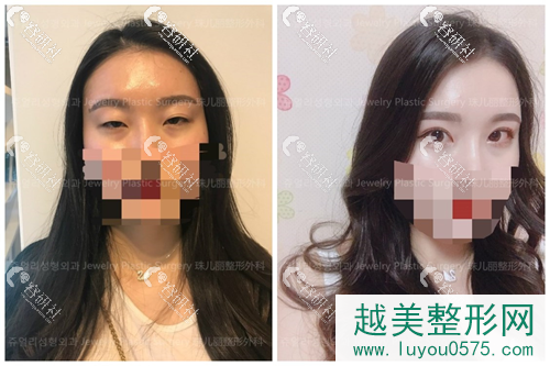 韩国珠儿丽医院双眼皮修复案例