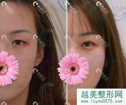 北京领医日式双眼皮案例果图