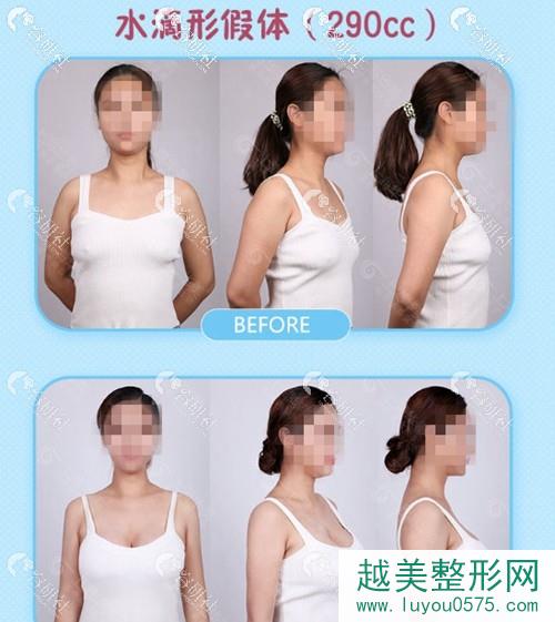 上海华美谢卫国水滴形假体隆胸案例