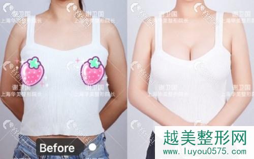 上海华美谢卫国傲诺拉假体隆胸案例展示