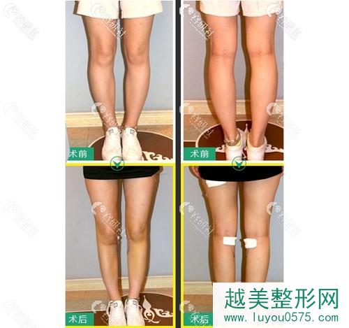 北京润美玉之光O型腿矫正案例