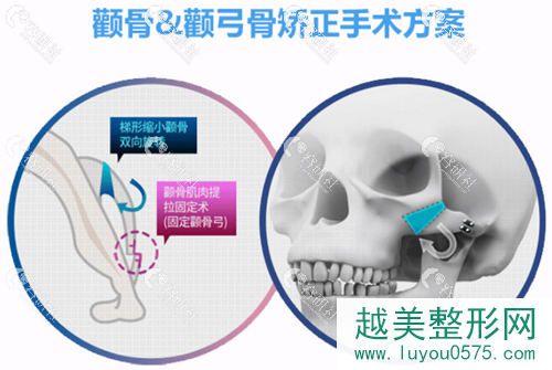 上海华美颧骨缩小手术方法