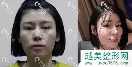 北京东方和谐医疗美容面部脂肪填充案例