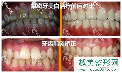 厦门铂菲特口腔氟斑牙治疗和牙齿矫正案例