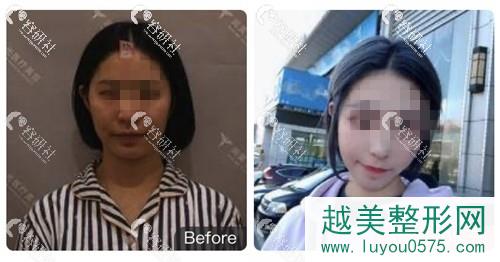 北京润美玉之光医院做的面部自体脂肪填充案例对比图