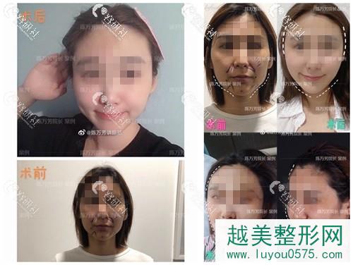 北京联合丽格医疗美容医院做的自体脂肪填充面部案例图