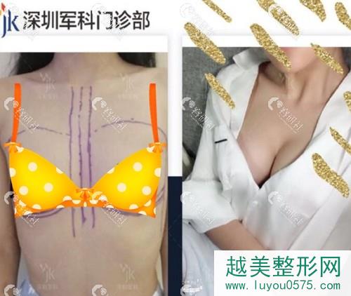 深圳军科刘月更假体隆胸前后对比图