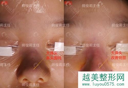 西安国 际医学中心医院隆鼻医生师俊莉鼻部手术案例