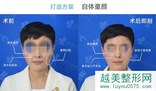 成都做面部提升抗衰技术好的医生刘小娇提升案例