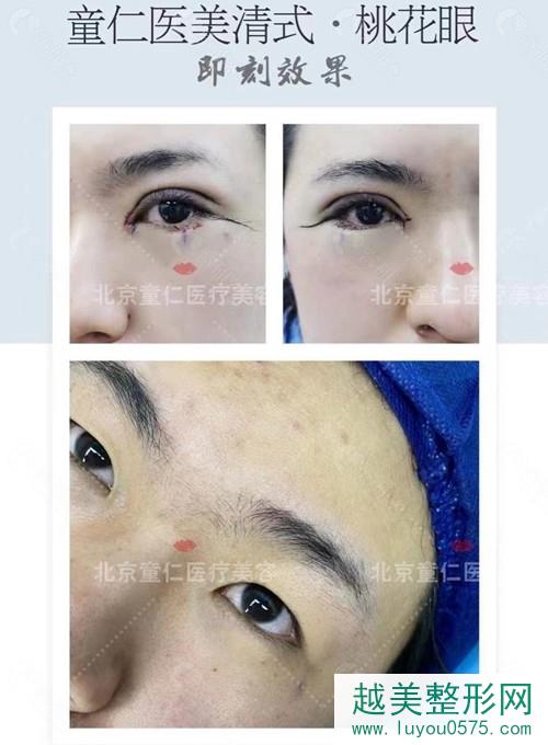 北京童仁欧素娇医生做的双眼皮案例对比图