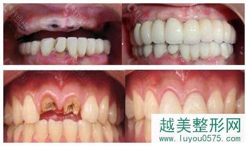 郑州卓 越口腔医院单颗牙，半口牙种植案例前后对比