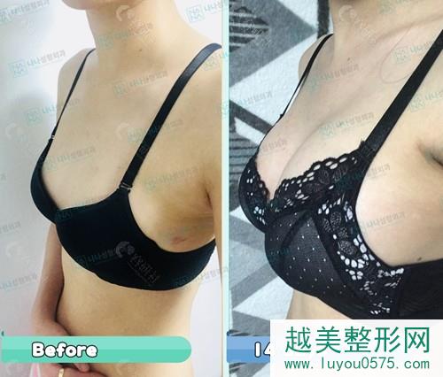韩国NANA整形外科假体隆胸前后果对比