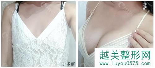 上海美莱医疗整形医院汪灏做假体隆胸案例前后对比