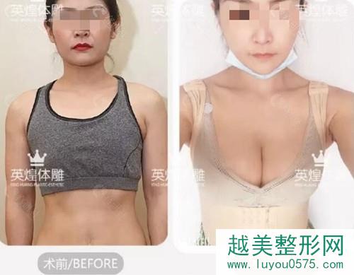 北京英煌梁耀婵自体脂肪隆胸案例
