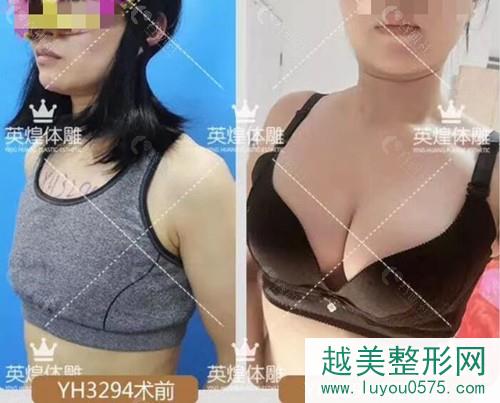 北京英煌梁耀婵自体脂肪隆胸术前术后对比