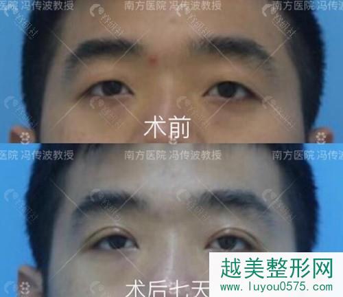 广州南方医科大学南方医院冯传波割双眼皮真人案例