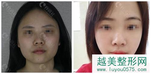 北京八大处杨斌做下颌角整形案例前后对比图