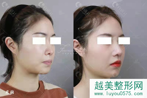 上海联合丽格医疗美容范荣杰隆鼻案例