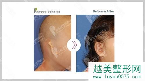 韩国普罗菲耳耳畸形矫正案例