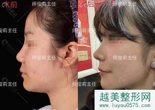 西安国 际医学师俊莉鼻部手术真人案例对比