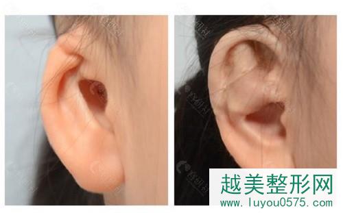 韩国普罗菲耳耳廓轻微畸形矫正案例分享