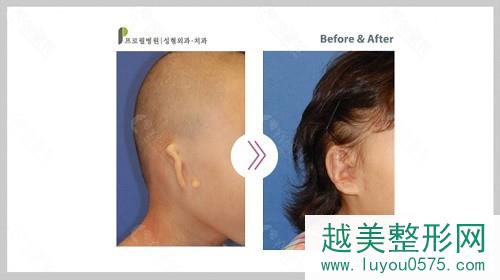 韩国普罗菲耳重度耳畸形患者矫正案例分享