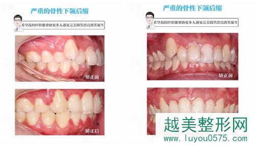 杭州美奥口腔医院牙齿矫正真人案例对比图
