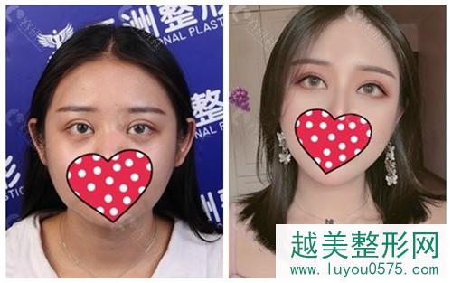 武汉五洲莱美双眼皮修复案例