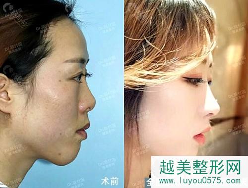 上海九院陈付国全肋软骨鼻修复术前术后20天案例