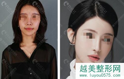 深圳富华隆鼻手术前后对比图