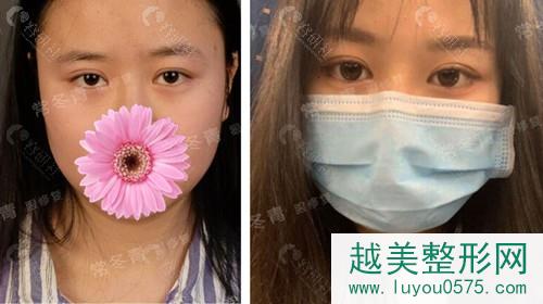 北京常冬青双眼皮修复真人案例