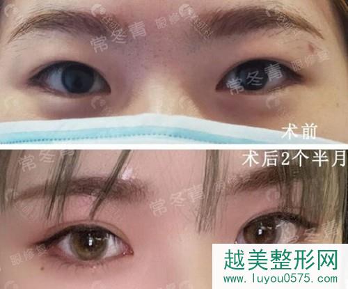 北京常冬青双眼皮修复真人案例果图