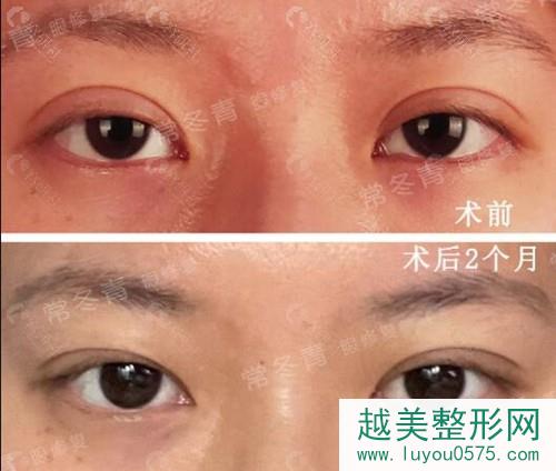 北京常冬青双眼皮修复术前术后对比