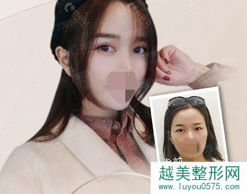 株洲宇芳姬医疗美容门诊部割双眼皮前后对比照片