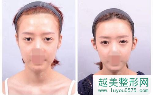 韩国profile普罗菲耳整形外科贴发耳矫正前后对比
