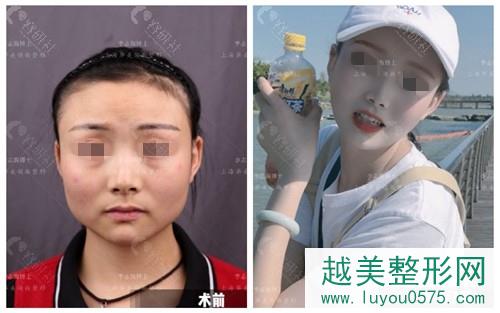 上海华美下颌角手术案例