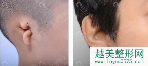 韩国普罗菲耳整形医院耳畸形矫正案例