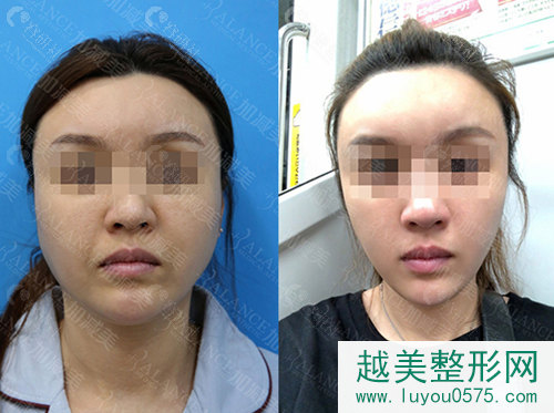 北京加减美面部提升前后对比照