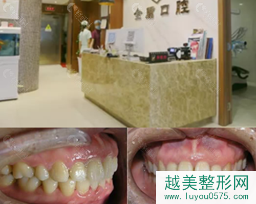 汉中金盾口腔牙齿矫正案例