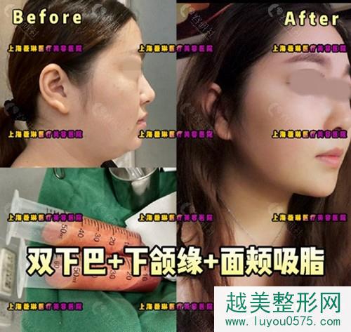 上海薇琳医疗美容医院面部吸脂前后对比