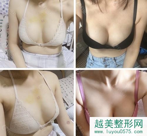 韩国普罗菲耳胸部下垂矫正真人案例