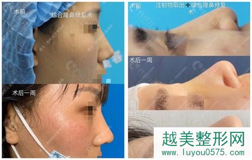 郑州大学第二附属医院隆鼻医生李钢鼻修复真人案例对比图