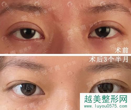 北京尚益嘉容常冬青双眼皮修复案例