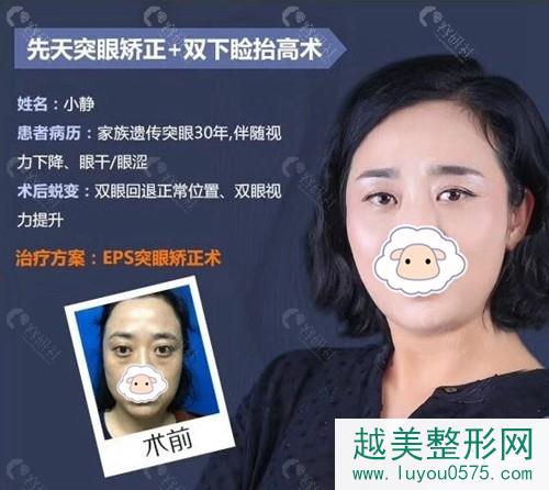 北京煤医夏成俊做先天突眼矫正术前术后对比图