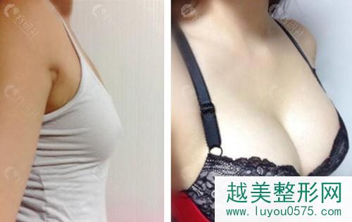 北京八大处穆大力隆胸术前术后对比