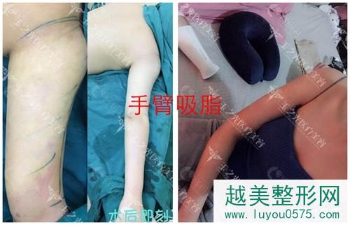 成都润美玉之光医院抽脂医生刘中国手臂吸脂案例对比 